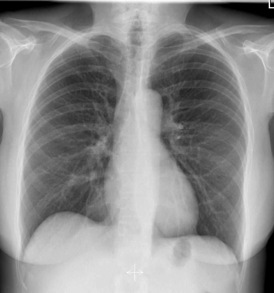 Akciğer Grafisi: Tanı ve Tedavi Sürecindeki Önemi