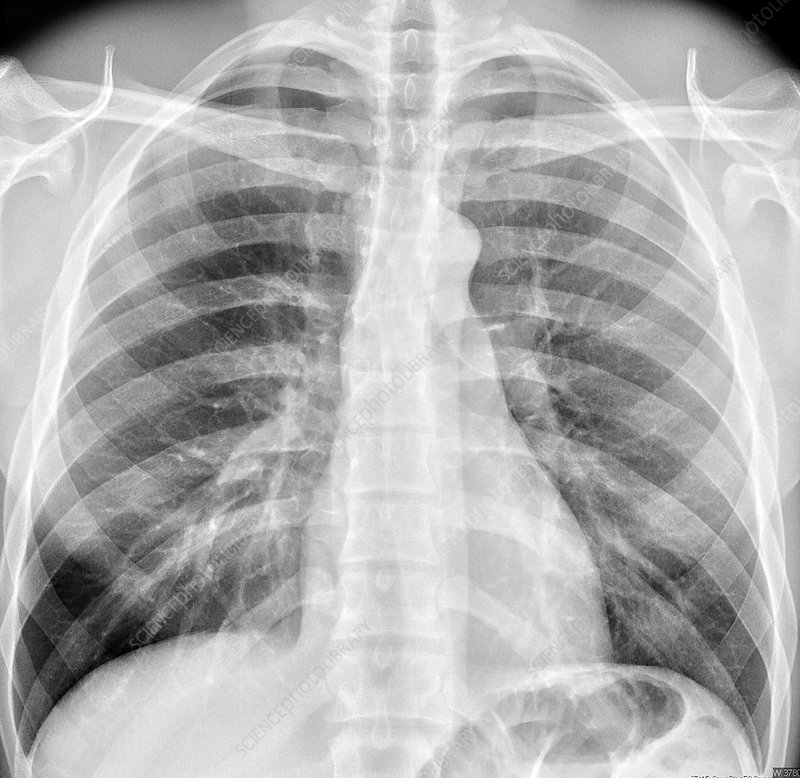 Akciğer Grafisi Nasıl Çekilir ve Yorumlanır?