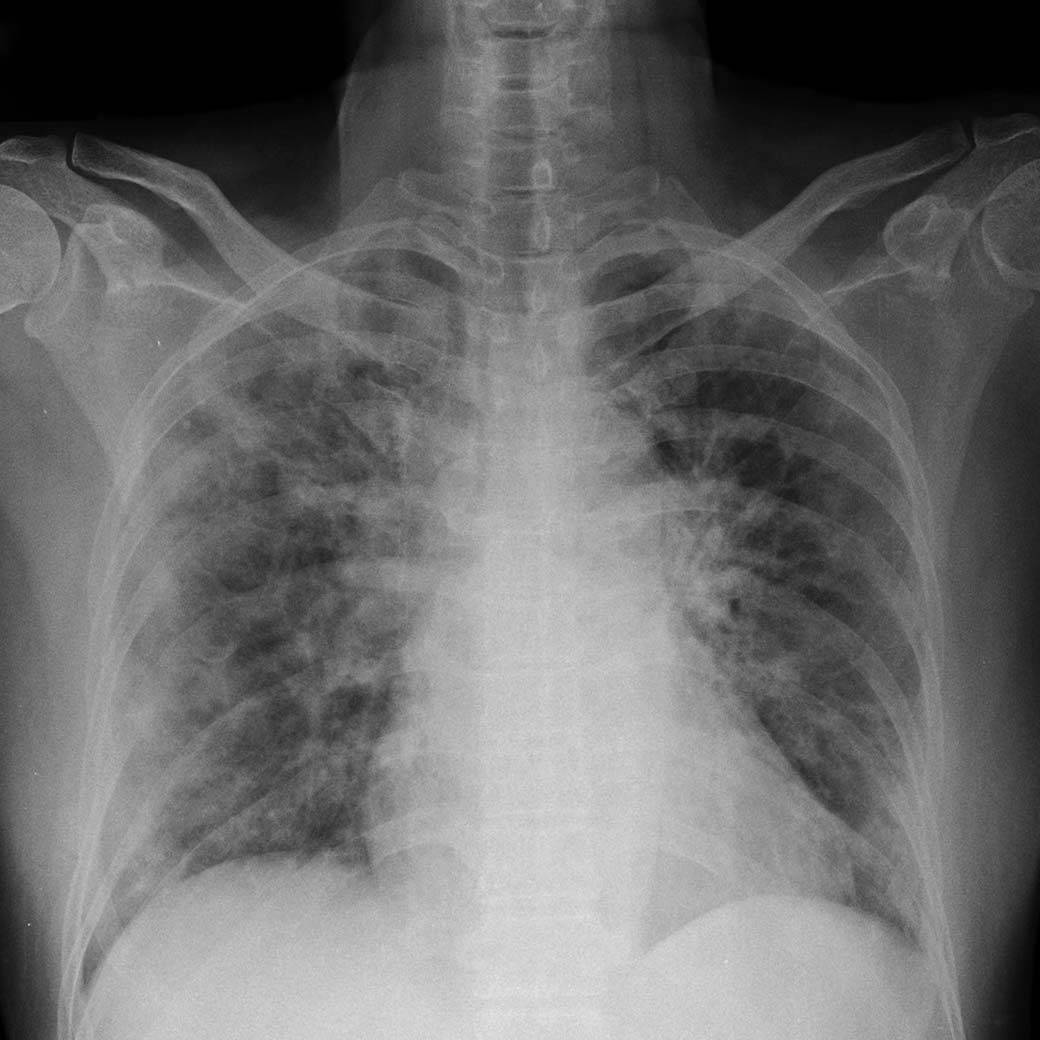 Akciğer Grafisi Sonuçları: Hangi Durumları Gösterebilir?